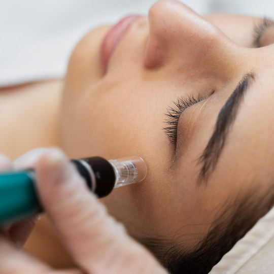 Skin Needling